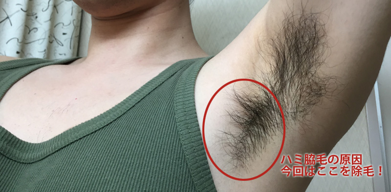 【男の脇毛除毛】ヌルリムーバークリームで脇毛の形を調整したら…